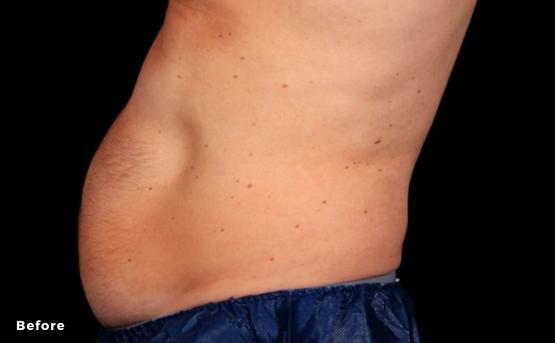 After Coolsculpting 